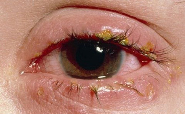 Nên hay không nên khi chữa bệnh đau mắt bằng mật ong